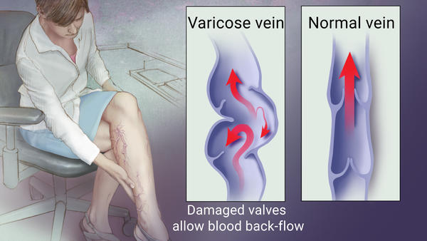 excercises for varicose veins