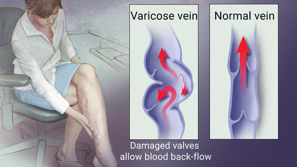 excercises for varicose veins-best exercises to prevent varicose veins